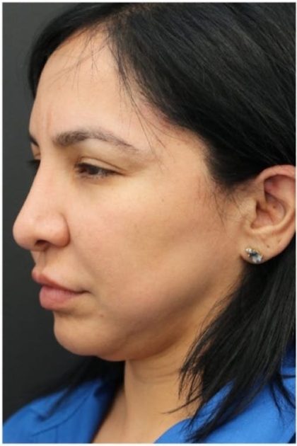 Aesthetic Facial Balancing Before & After Patient #1130