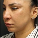 Aesthetic Facial Balancing Before & After Patient #1130