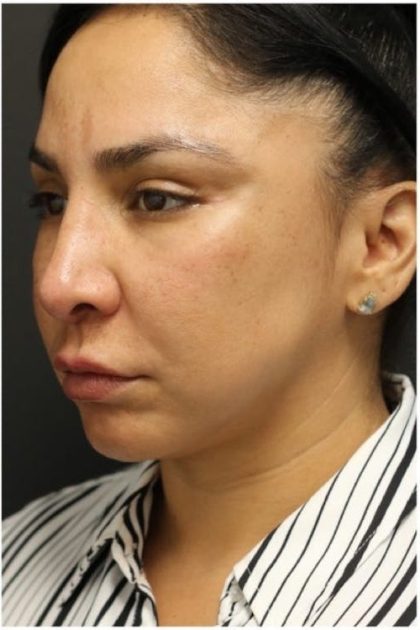 Aesthetic Facial Balancing Before & After Patient #1130