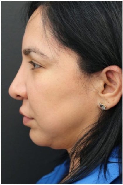 Aesthetic Facial Balancing Before & After Patient #1130