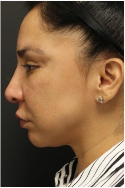 Aesthetic Facial Balancing Before & After Patient #1130