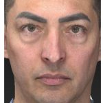 Aesthetic Facial Balancing Before & After Patient #1129