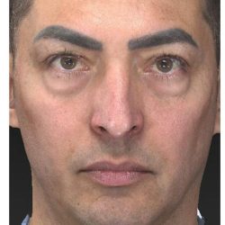 Aesthetic Facial Balancing Before & After Patient #1129