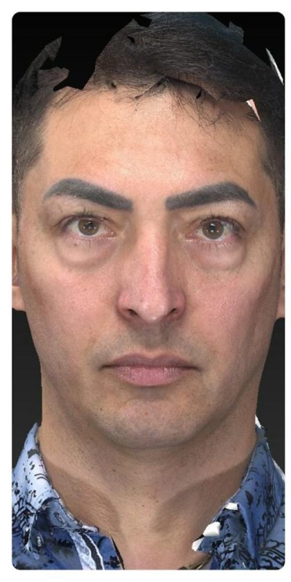 Aesthetic Facial Balancing Before & After Patient #1129