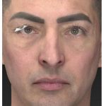 Aesthetic Facial Balancing Before & After Patient #1129