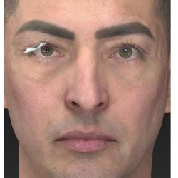 Aesthetic Facial Balancing Before & After Patient #1129