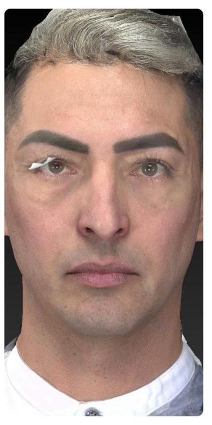 Aesthetic Facial Balancing Before & After Patient #1129