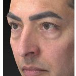 Aesthetic Facial Balancing Before & After Patient #1129
