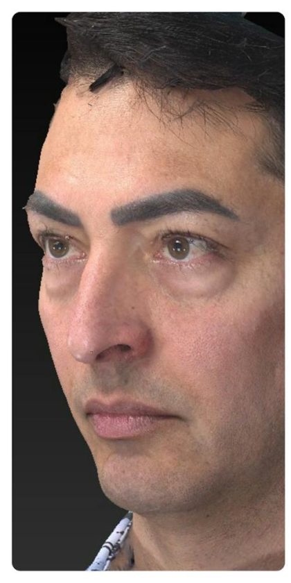 Aesthetic Facial Balancing Before & After Patient #1129