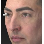 Aesthetic Facial Balancing Before & After Patient #1129