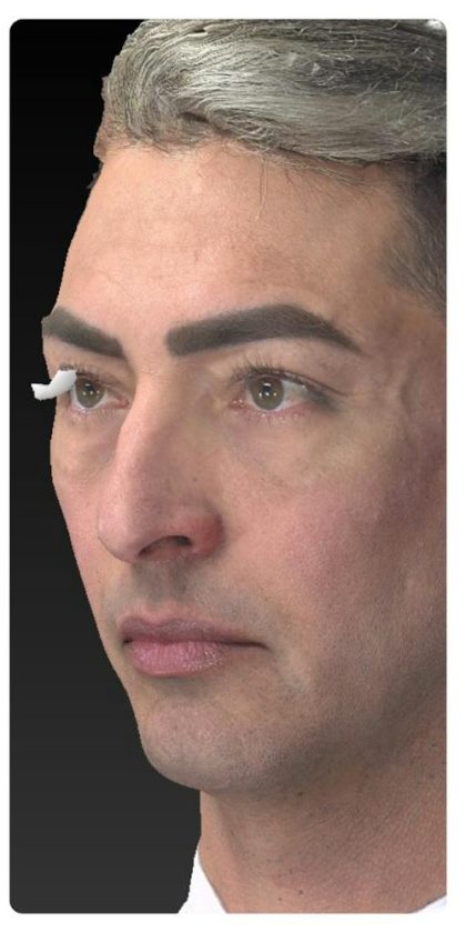 Aesthetic Facial Balancing Before & After Patient #1129
