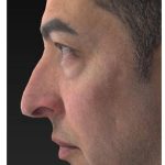 Aesthetic Facial Balancing Before & After Patient #1129