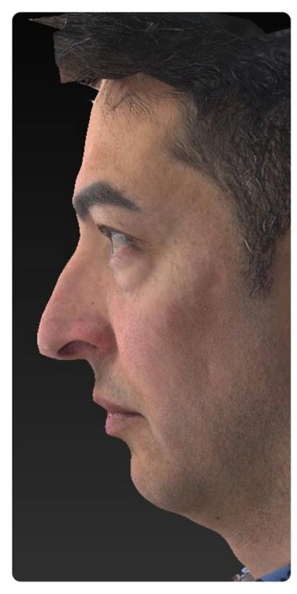 Aesthetic Facial Balancing Before & After Patient #1129