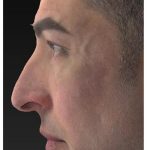 Aesthetic Facial Balancing Before & After Patient #1129