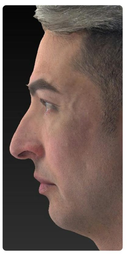 Aesthetic Facial Balancing Before & After Patient #1129