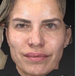 Aesthetic Facial Balancing Before & After Patient #1128