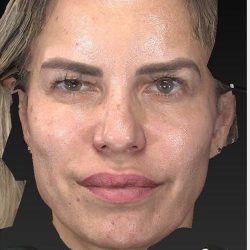 Aesthetic Facial Balancing Before & After Patient #1128