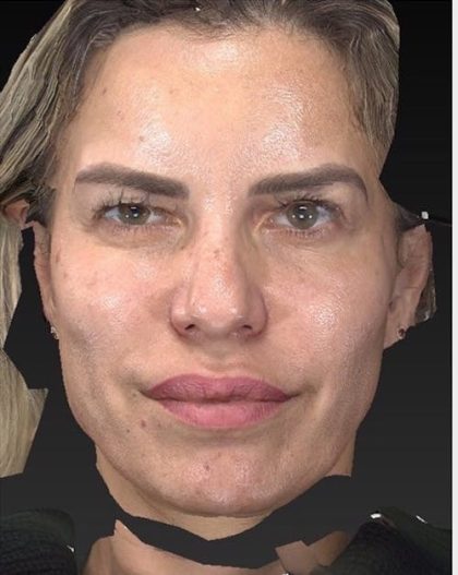 Aesthetic Facial Balancing Before & After Patient #1128
