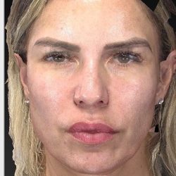 Aesthetic Facial Balancing Before & After Patient #1128