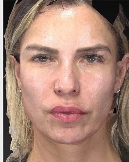 Aesthetic Facial Balancing Before & After Patient #1128