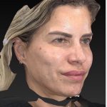 Aesthetic Facial Balancing Before & After Patient #1128