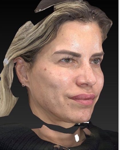 Aesthetic Facial Balancing Before & After Patient #1128