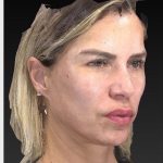 Aesthetic Facial Balancing Before & After Patient #1128