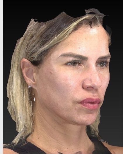 Aesthetic Facial Balancing Before & After Patient #1128