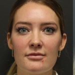 Aesthetic Facial Balancing Before & After Patient #1127
