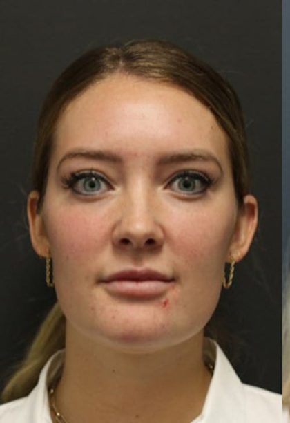 Aesthetic Facial Balancing Before & After Patient #1127