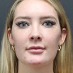 Aesthetic Facial Balancing Before & After Patient #1127