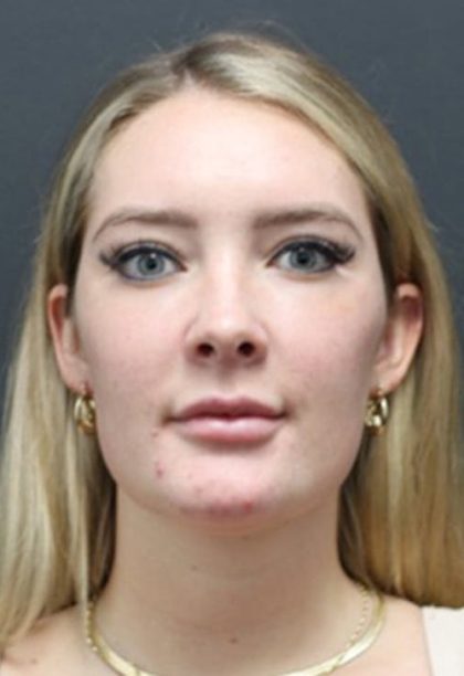 Aesthetic Facial Balancing Before & After Patient #1127