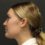 Aesthetic Facial Balancing Before & After Patient #1127
