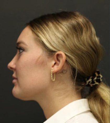 Aesthetic Facial Balancing Before & After Patient #1127