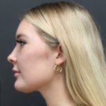 Aesthetic Facial Balancing Before & After Patient #1127