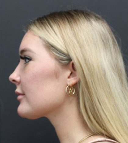 Aesthetic Facial Balancing Before & After Patient #1127