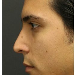 Aesthetic Facial Balancing Before & After Patient #1126