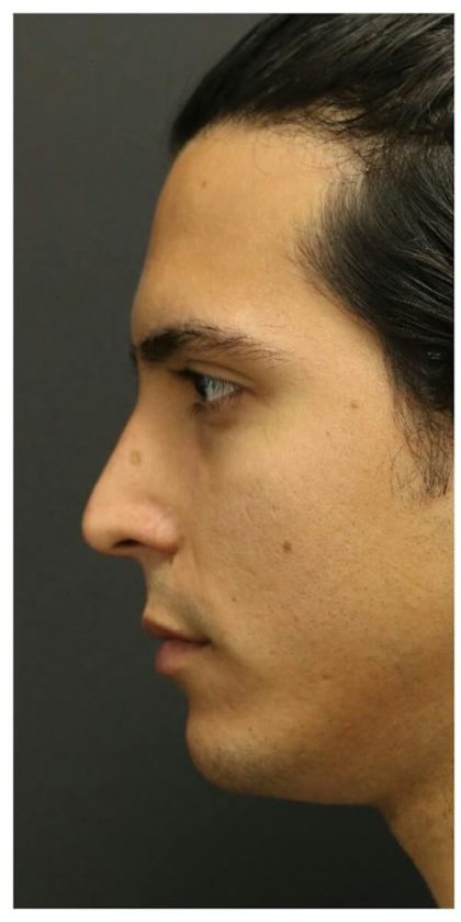 Aesthetic Facial Balancing Before & After Patient #1126