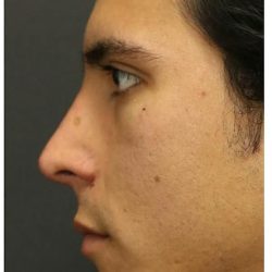 Aesthetic Facial Balancing Before & After Patient #1126