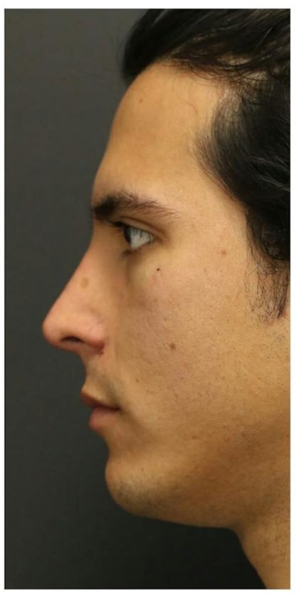 Aesthetic Facial Balancing Before & After Patient #1126