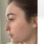 Aesthetic Facial Balancing Before & After Patient #1125