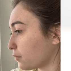 Aesthetic Facial Balancing Before & After Patient #1125