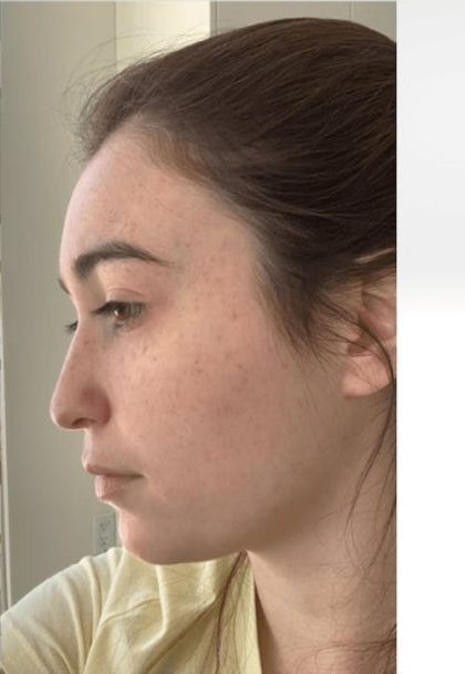 Aesthetic Facial Balancing Before & After Patient #1125