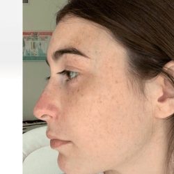 Aesthetic Facial Balancing Before & After Patient #1125