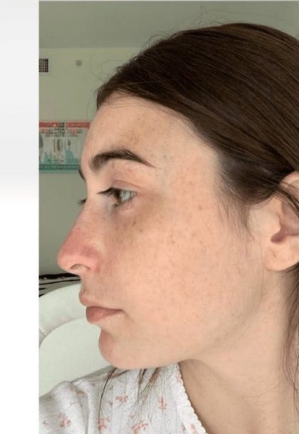 Aesthetic Facial Balancing Before & After Patient #1125