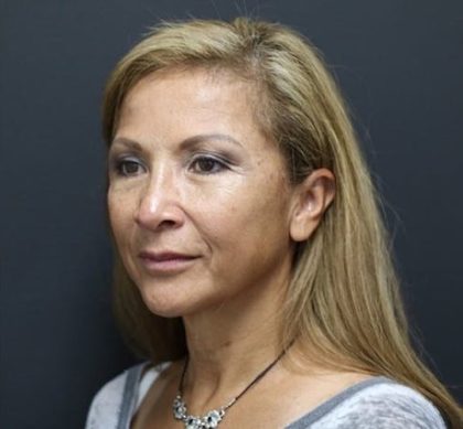 Aesthetic Facial Balancing Before & After Patient #1124