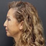 Aesthetic Facial Balancing Before & After Patient #1124