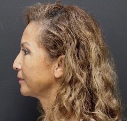 Aesthetic Facial Balancing Before & After Patient #1124