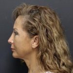 Aesthetic Facial Balancing Before & After Patient #1124