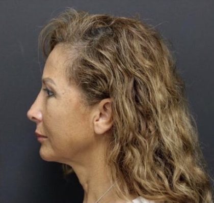 Aesthetic Facial Balancing Before & After Patient #1124